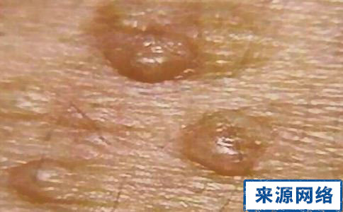 Ƥ��֬��������ν�����ʳ����